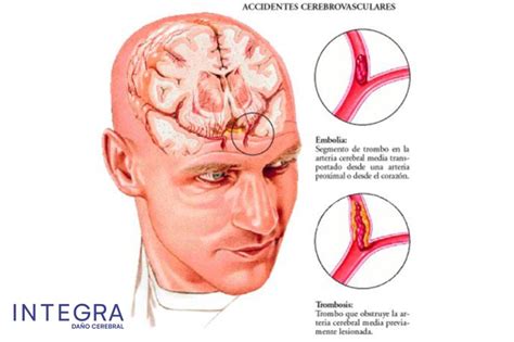 ¿Qué es un ictus? Tipos de ictus, causas y recomendaciones | Integra ...