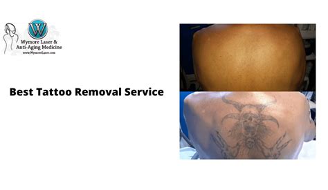 Call Wymore Laser For Best Tattoo Removal Service In Orlando