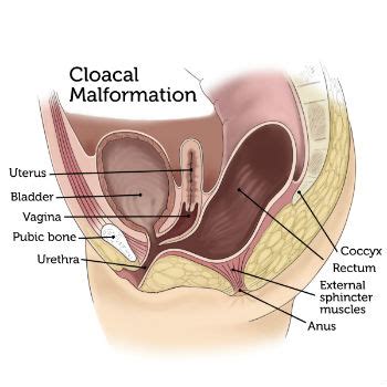 Cloacal Deformities | Boston Children's Hospital