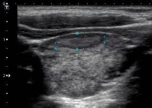 A few observations on thyroid ultrasound - Dr Iain Duncan