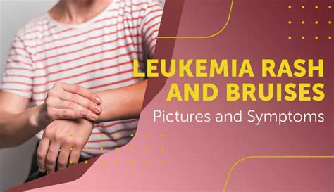 Leukemia Rash and Bruises: Pictures and Symptoms | MyLeukemiaTeam