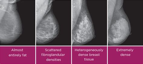 Breast Density: Understanding its Significance and Impact on Breast Health | Consulting Radiologists