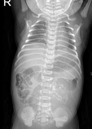 Fetus in fetu | Radiology Case | Radiopaedia.org