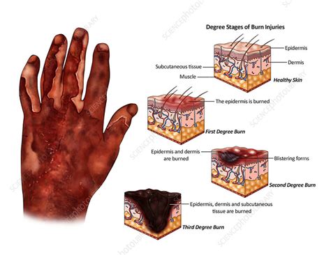 Degree Stages of Burn Injuries, illustration - Stock Image - C039/3474 ...