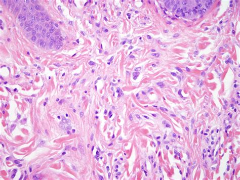 Fibrous Papule | Dermatopathology