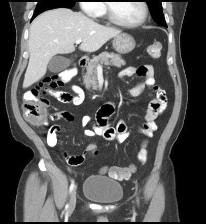 Viewing playlist: UQ Med Yr 1 GIT: Bowel | Radiopaedia.org