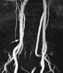 23 Branchial Cleft Cyst | Radiology Key