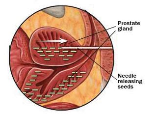 Brachytherapy| Maryland Prostate Cancer Care