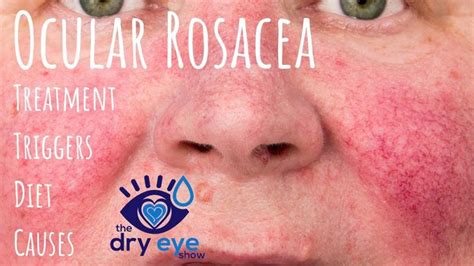 Best Of Best Eye Makeup Remover For Ocular Rosacea And View | Ocular ...