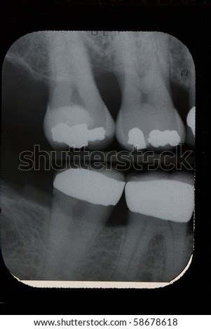 Dental Xray Vertical Bitewings Right Molar Stock Photo 58678618 ...