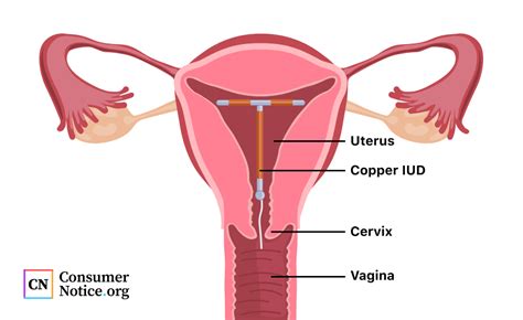 Paragard IUD | Insertion and Removal, Side Effects, Litigation