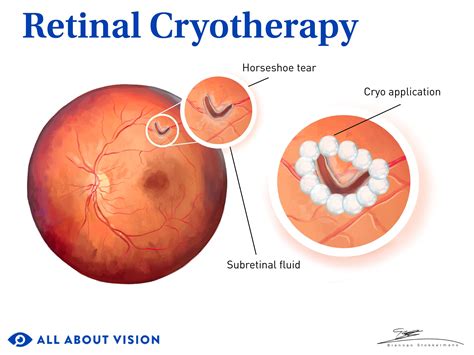 What Is Cryopexy (Retinal Cryotherapy)?