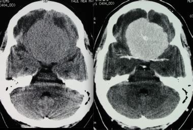 Brain Meningioma Imaging: Overview, Radiography, Computed Tomography