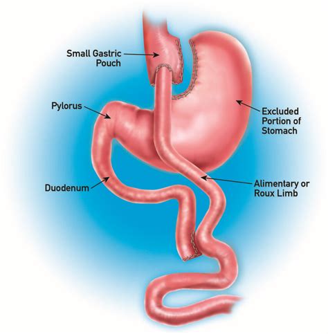 Gastric Bypass Surgery in Dallas & Plano | Dr Malladi