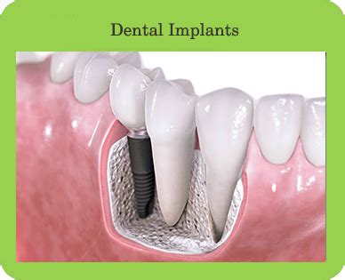 Dental Implants, Houston, TX | John Roane DDS