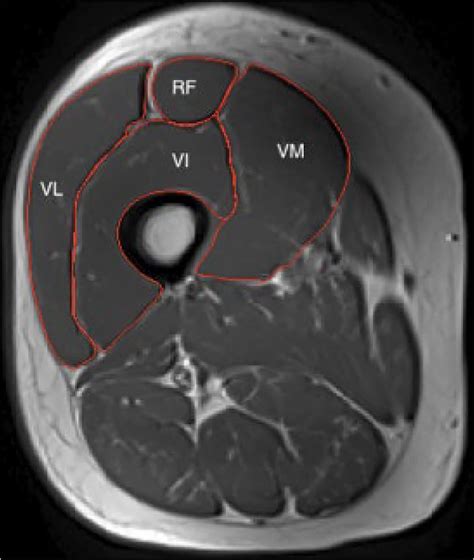 Rectus Femoris Muscle Mri Anatomy