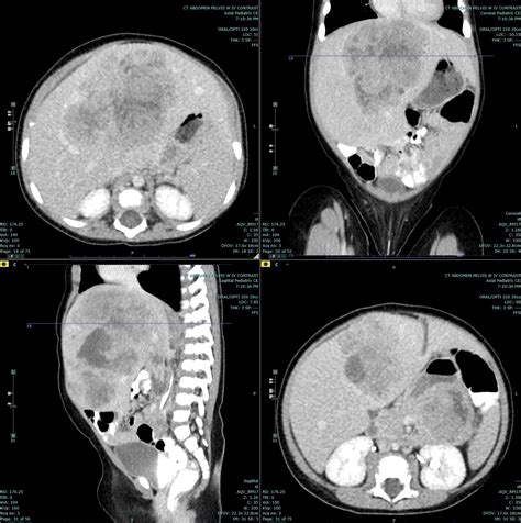 Hepatoblastoma Article