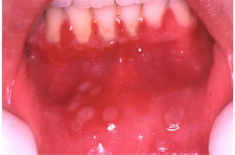 Herpes Simplex Virus (Hsv) Infection Of The Mouth – European ...