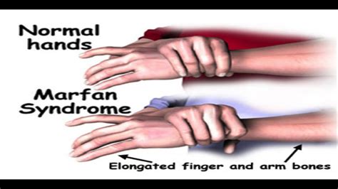 Thumb Sign In Marfan Syndrome - Captions Hunter