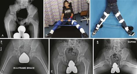 Legg-Calvé-Perthes Disease | Musculoskeletal Key