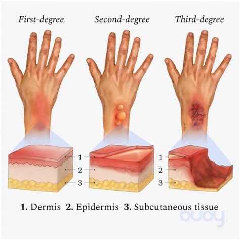 The 3 Types Of Burns – First Degree, Second Degree, Third Degree | Daily Infographic