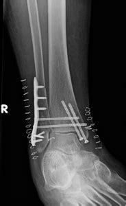 Case Report: Trimalleolar Fracture - Sports Medicine Review