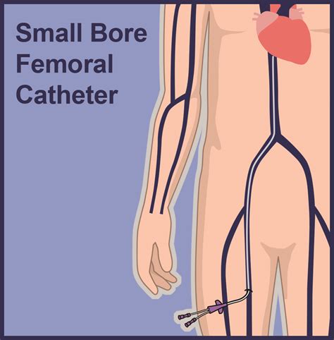 Mid-Thigh Femoral Central Lines | Vascular Wellness