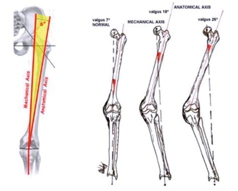 Valgus Deformity Correction in Total Knee Replacement: An Overview ...