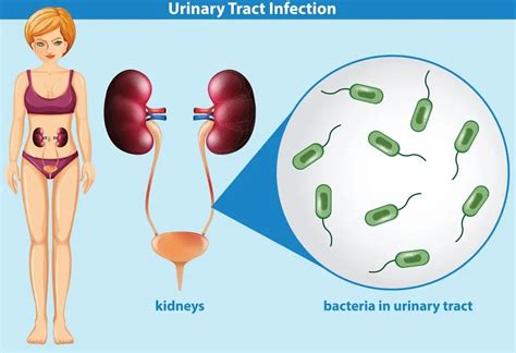 Leukocytes in Urine While Pregnant: Causes & Treatment