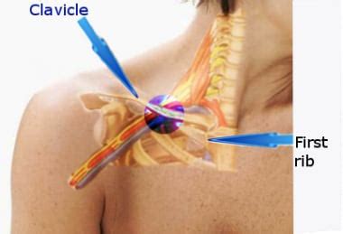 Subclavian Vein Thrombosis: Practice Essentials, Anatomy, Pathophysiology