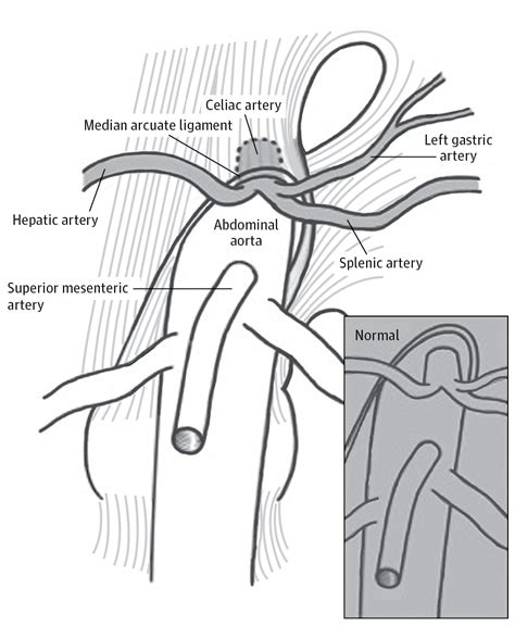 Median Arcuate Ligament Syndrome—Review of This Rare Disease. | Congenital Defects | JAMA ...