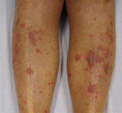 The Causes And Treatment Of Lichen Planus | Health And Beauty