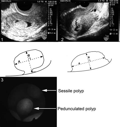 Representative size measurement and appearance of endometrial polyps.... | Download Scientific ...