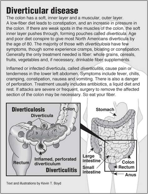 25+ bästa Diverticulitis symptoms idéerna på Pinterest | Divertikulit ...