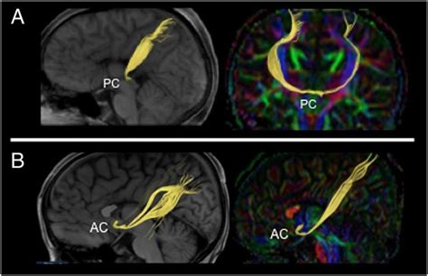 (A) posterior commissure tract in both sagittal T1 weighted image MRI ...