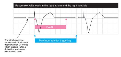 Basic cardiac pacing, pacemaker functions and settings (2022)