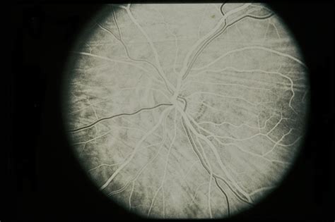 Optic Nerve Meningioma - Retina Image Bank