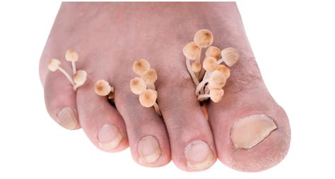 Athlete's foot - New Medicine Online - GNM practitioner