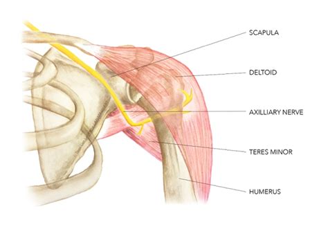 Anterior Shoulder Dislocation Axillary Nerve