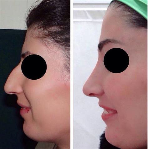 before and after nose contouring (4) » Rhinoplasty: Cost, Pics, Reviews, Q&A