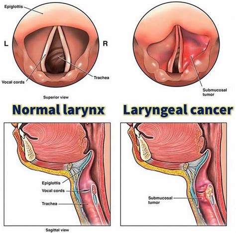 Larynx - Anatomy, Function in Respiratory System - Cancer Symptoms