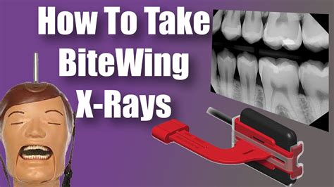 Bitewings X Rays - Dental Tips and Tricks - YouTube