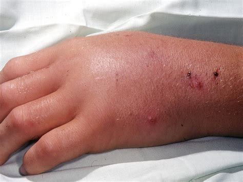 How to identify snake, spider bites: Australia’s most common stings ...