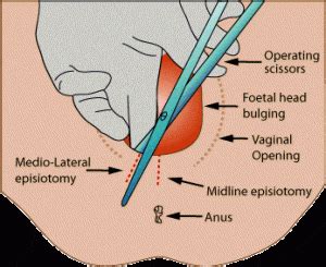 medio-lateral-episiotomy | Madriella Network