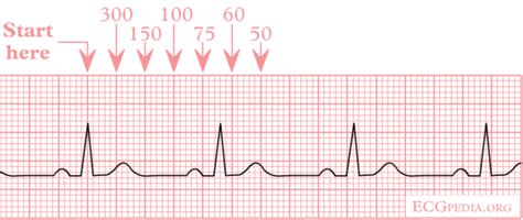 Hartfrequentie - ECGpedia