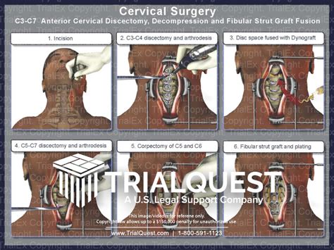 Cervical Surgery - TrialQuest Inc.