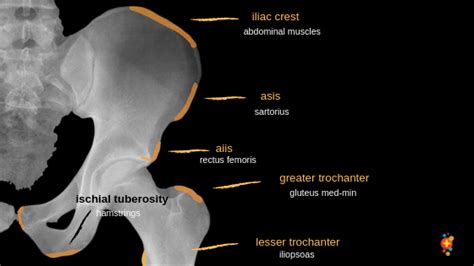 Pelvic avulsion injuries