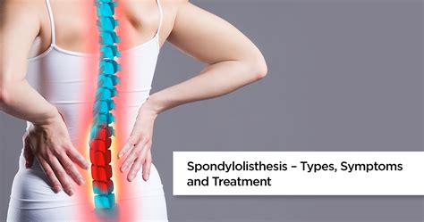 Spondylolisthesis | Treatment and Symptoms of Spondylolisthesis