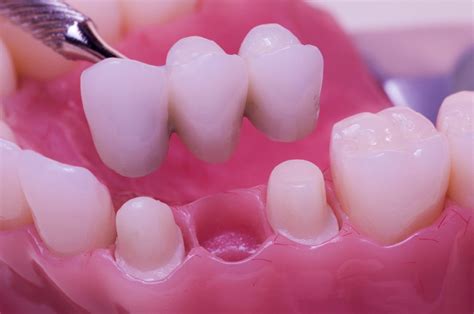 Custom Dental Bridge vs Dental Implants