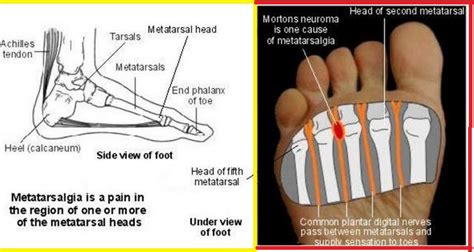 Metatarsalgia - Treatment, Symptoms, Exercises, Shoes, Causes